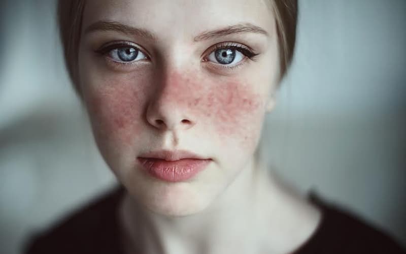 Au Canada, le lupus touche environ 1 personne sur 2 000.